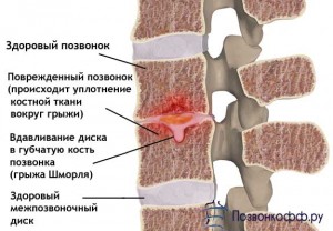 межпозвоночная грыжа шморля