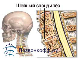 Остеохондроз грудного отдела позвоночника признаки Остеопатическая клиника ЦВТО