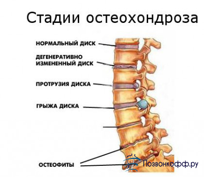 гимнастика для шеи при остеохондрозе