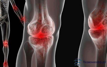 Лечение артроза коленного сустава первой степени