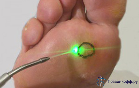 Лечение артроза большого пальца стопы лазером