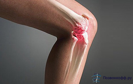 Cиновит коленного сустава
